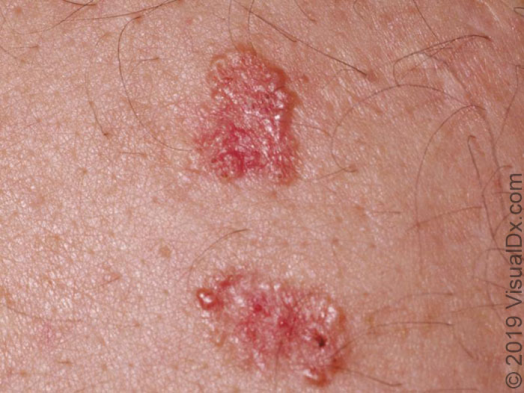 Painless Skin Lesions Might Be Skin Cancer!