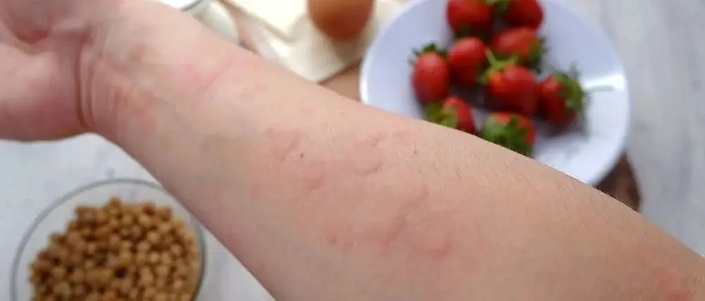 Preventing Baby Food Allergies: Common Mistakes You Should Avoid!