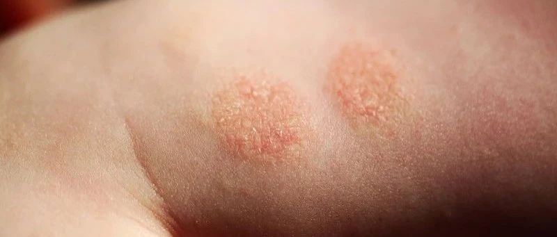Itchy and Recurrent! If You Have Eczema, You Need to Know These Facts